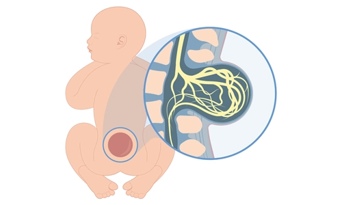 Spina Bifida Nedir? Belirtileri, Tanı ve Tedavisi