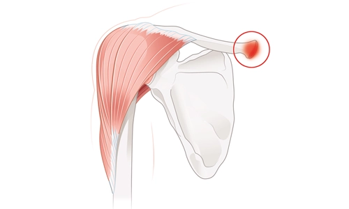 Sternoklaviküler Eklem Yaralanması: Travmatik & Dejeneratif