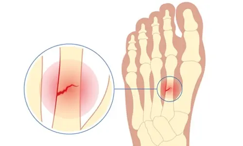 Stres Kırığı Nedir? Tanısı ve Tedavisi