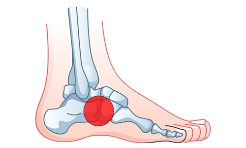 Tarsal Koalisyon Nedir? Tanısı, Tedavisi ve Ameliyatı