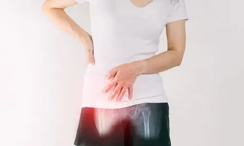 Trokanterik Bursit Nedir? Belirtileri Nelerdir?