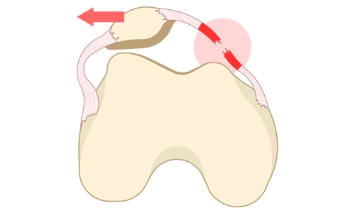 Troklear Displazi Nedir? Belirtileri, Tanısı ve Tedavisi