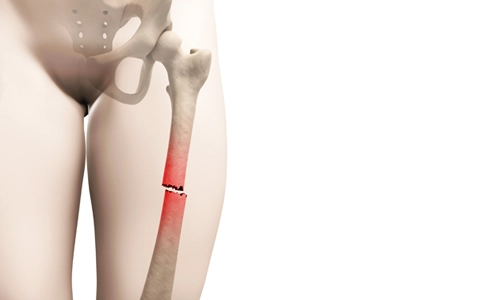 Uyluk Kemiği Kırığı (Femur)