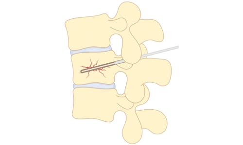 Vertebroplasti Ameliyatı Fiyatı Nasıl Hesaplanır?