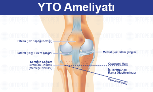 Yüksek Tibial Osteotomi (YTO) Ameliyatı