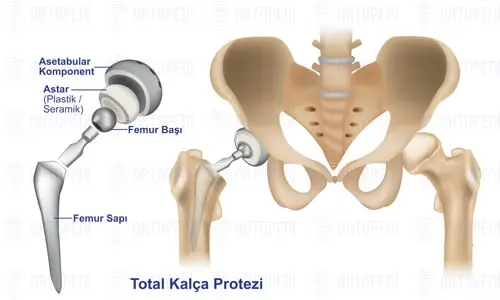 Total Kalça Protezi Ameliyatı Nasıl Yapılır?