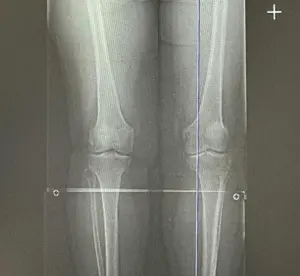 Parantez bacak (0 bacak) eğriliği nedeniyle YTO (yüksek tibial osteotomi) ameliyatı planlanan hastanın ameliyat öncesi bacak uzunluk filmi.