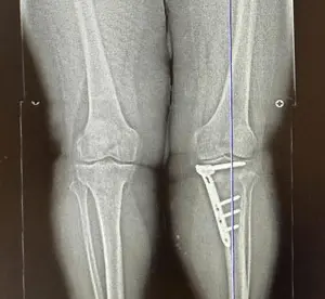 Parantez bacak (O bacak) eğriliği nedeniyle YTO (yüksek tibial osteotomi) ameliyatı yapılan hastanın ameliyat sonrası bacak uzunluk filmi.