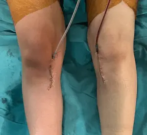 Parantez bacak (O bacak) eğriliği nedeniyle, YTO (yüksek tibial osteotomi) ameliyatı yapılan hastanın ameliyat sonrası görüntüsü.