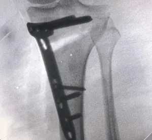 YTO (Yüksek tibial osteotomi) ameliyatında düzeltme sonrası bacak kemiğinin plak vidalar ile sabitlenmesi.