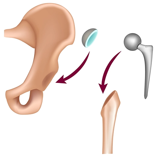 Femur başı ve yuva için uygun implant boylarının ayarlanması.
