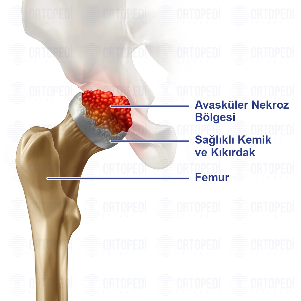 Avasküler Nekroz Ameliyatı Nedir? Belirtileri ve Tedavisi