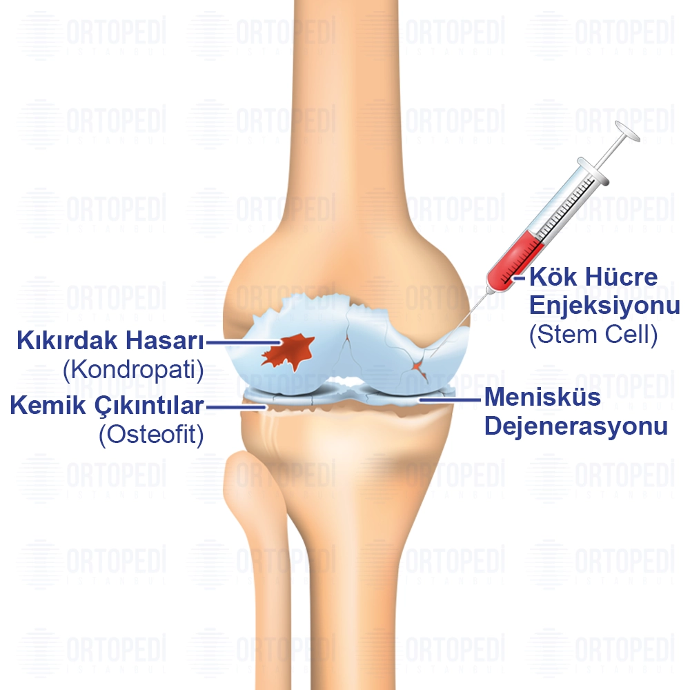 Kök Hücre Tedavisi Nedir? Nasıl Yapılır?