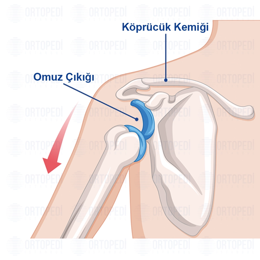 Omuz Çıkığı Nedir? Tedavisi ve Ameliyatı
