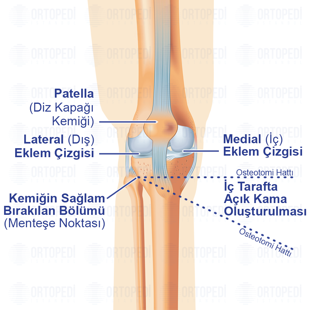 Yüksek Tibial Osteotomi (YTO) Ameliyatı