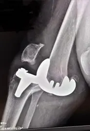 Gevşeme sebebiyle gerçekleşen protez diz çıkığının röntgen görüntüsü.
