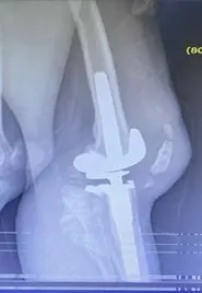 Revizyon diz protezi ameliyatı sonrasında diz röntgenleri.