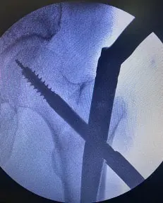 Ameliyat esnasında PFN çivisi ameliyatı yapılmış ve tam anatomik redüksiyon sağlanmış şekilde röntgen görüntüsü. Bu hastamız stabil bir fiksasyon sonrası üzerine yük verip basabildi. Ameliyat sonrası 6. Saatte hemen üstüne basarak yürüdü.