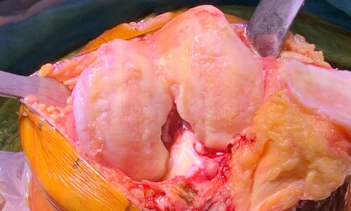 Joint Cartilages in the Impaired Knee