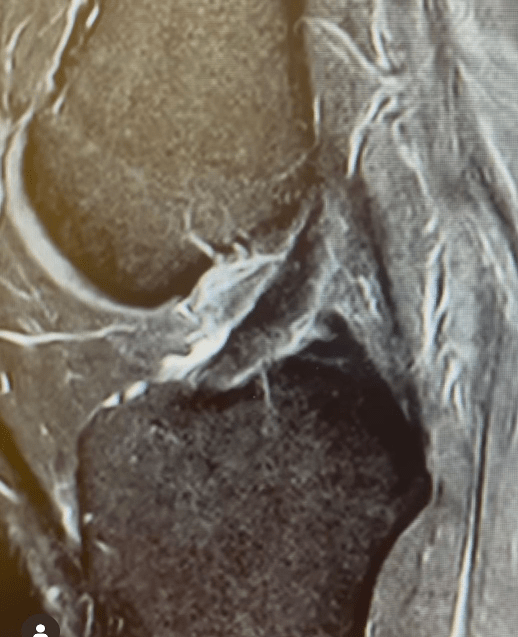 Anterior cruciate ligament seen intact on knee MRI.