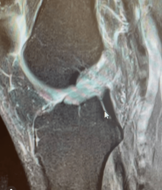Anterior cruciate ligament torn in knee MRI.