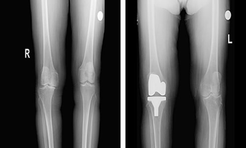 Knee Arthroplasty