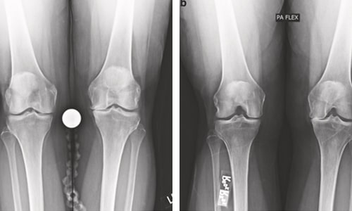 Cartilage Damage in the Knee