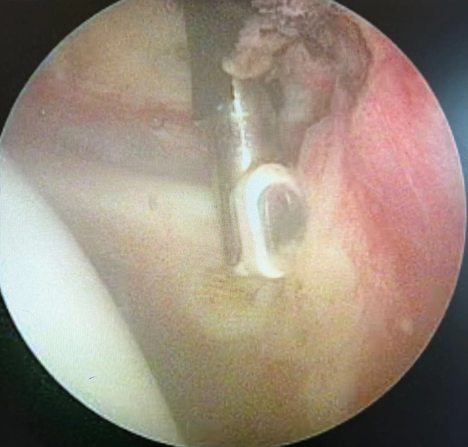 Donuk ameliyatı Artroskopik görüntüsü