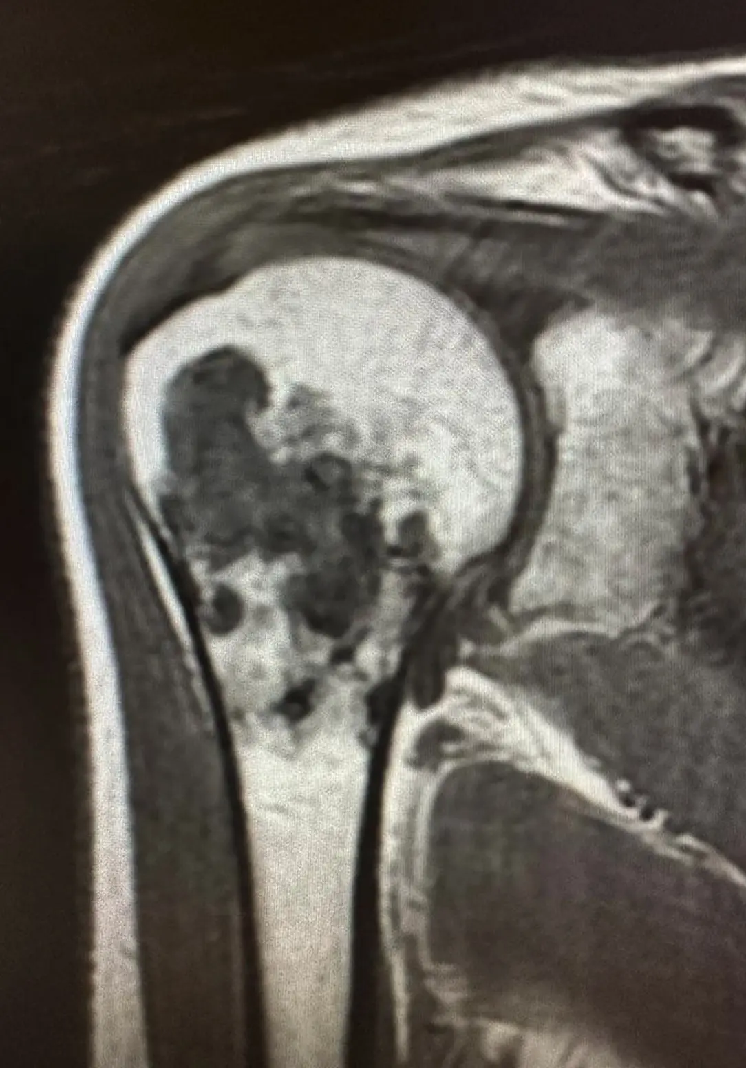 Humerus (kol kemiği) üst uçta kemik tümörü T1 MRI görüntüsü.