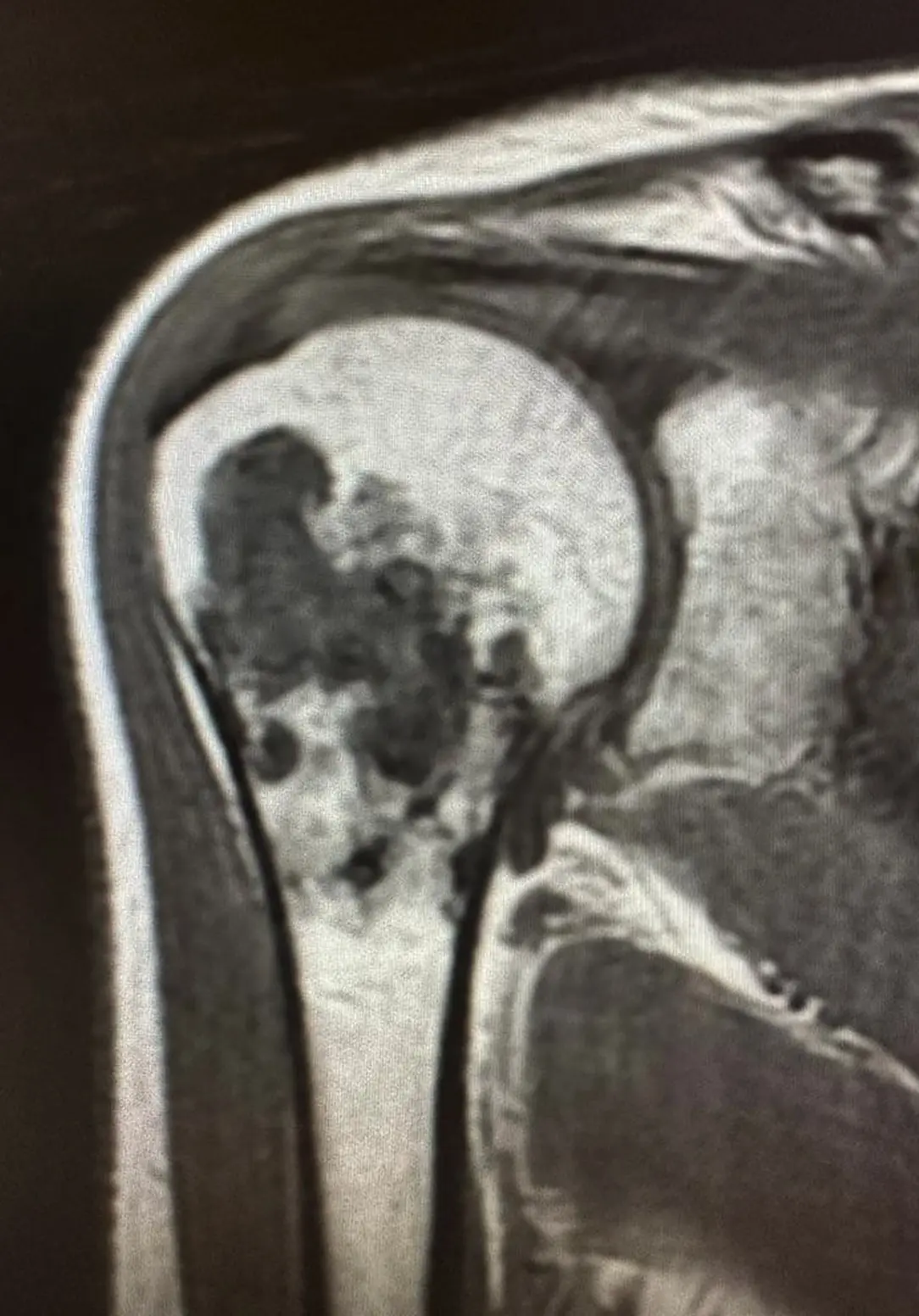 T1 MRI image of bone tumor at the upper end of the humerus (arm bone).