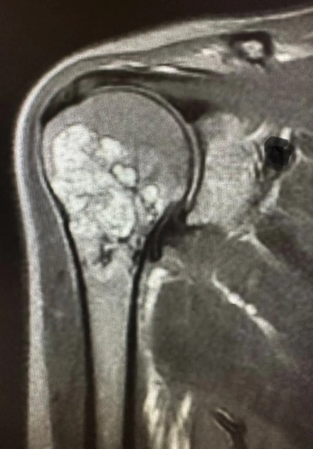 Humerus (kol kemiği) üst uçta kemik tümörü T2 MRI görüntüsü.
