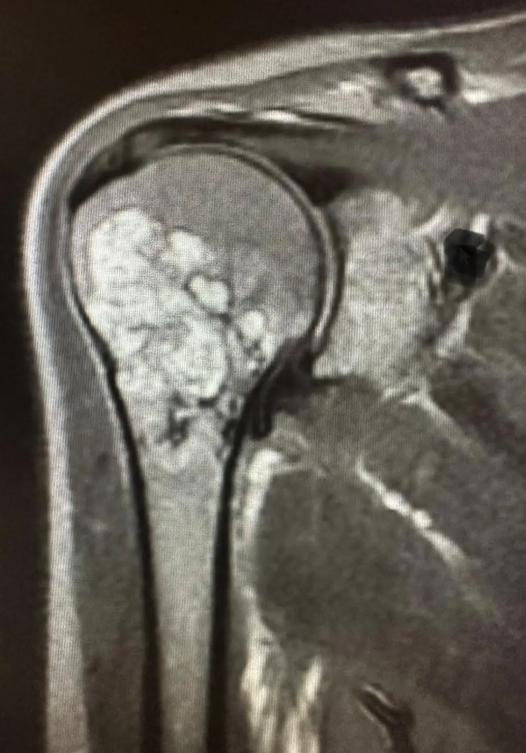 T2 MRI image of bone tumor at the upper end of the humerus (arm bone).