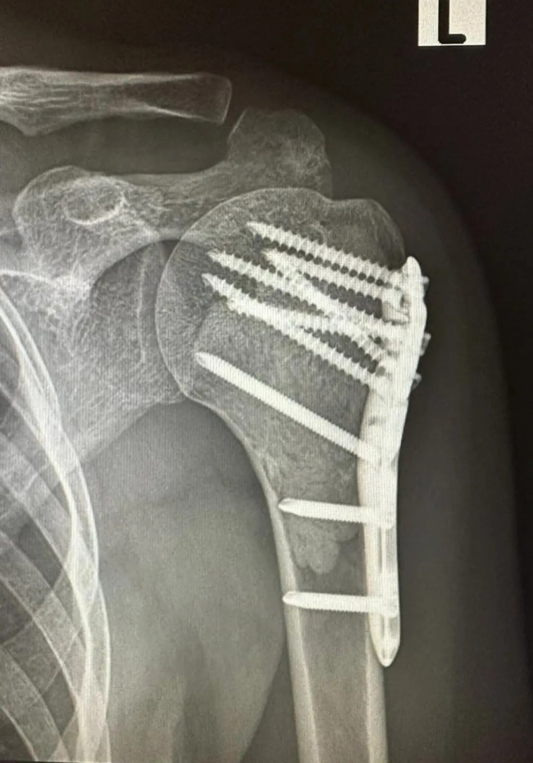 Humerus üst uç kitle-biyopsi sonucu Grade 1 Kondrosarkom olarak gelen hastaya yapılan küretaj -sementasyon - plaklama ameliyatı X-Ray röntgen görüntüsü.