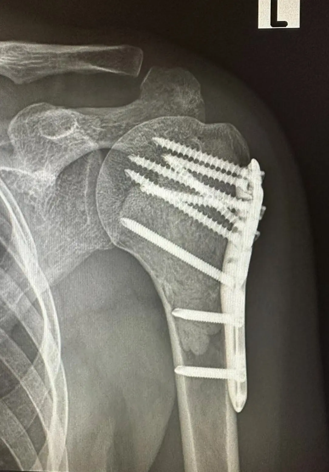 X-Ray image of curettage - cementation - plating surgery performed on a patient whose humerus upper end mass-biopsy result was found to be Grade 1 Chondrosarcoma.