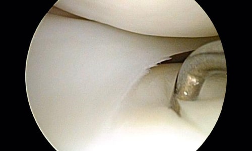 What is a Meniscus Tear?