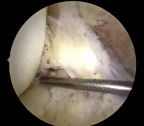 Arthroscopy image of anterior cruciate ligament partial injury.