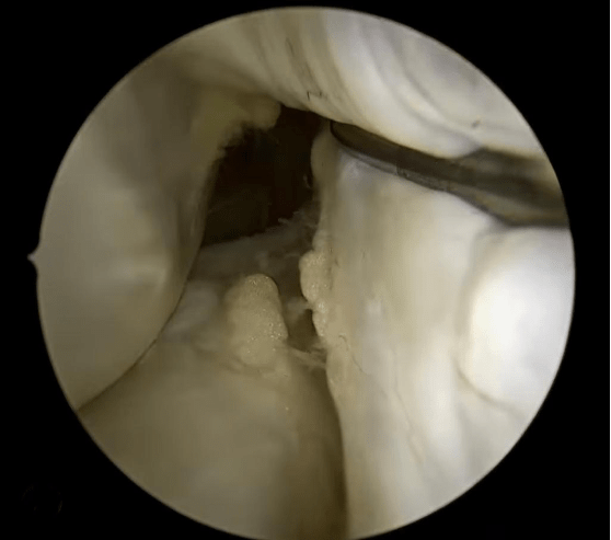 Arthroscopy image of anterior cruciate ligament full thickness injury.