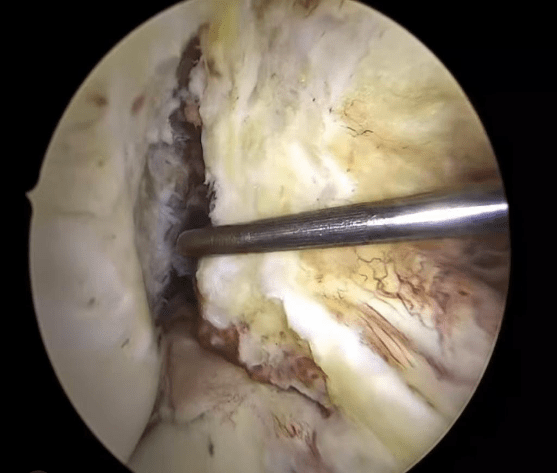 Arthroscopy image of anterior cruciate ligament full thickness injury.