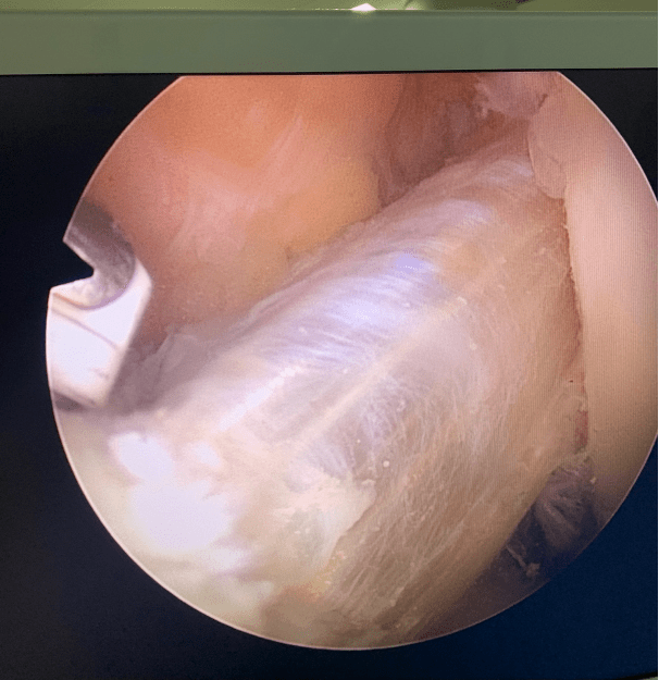 Arthroscopic view after reconstruction (new anterior cruciate ligament with ligament transplantation).