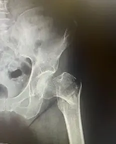 Resimde sol kalça kırığı görülmektedir. Yolda dolmuştan düşme sonucu sol kalça kırığı geçiren 60 yaşında kadın hastanın kırık röntgen görüntüsü.