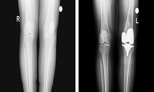 Total Knee Arthroplasty