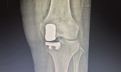 Half Knee Prosthesis (Unicondylar Knee Prosthesis)