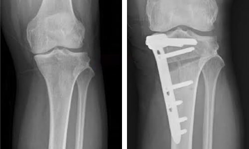 High Tibial Osteotomy